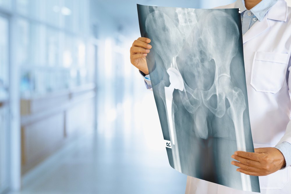 5 Signs It's Time to Consider a Hip Replacement: Ortho 1 Medical Group:  Orthopedic Specialists