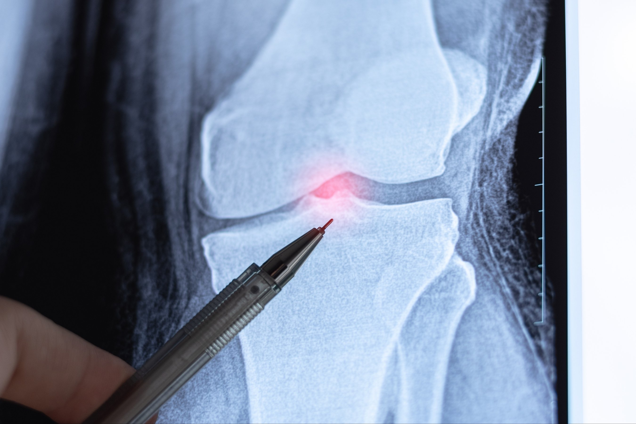 Doctor learn X-ray of Knee joint dislocation after accident