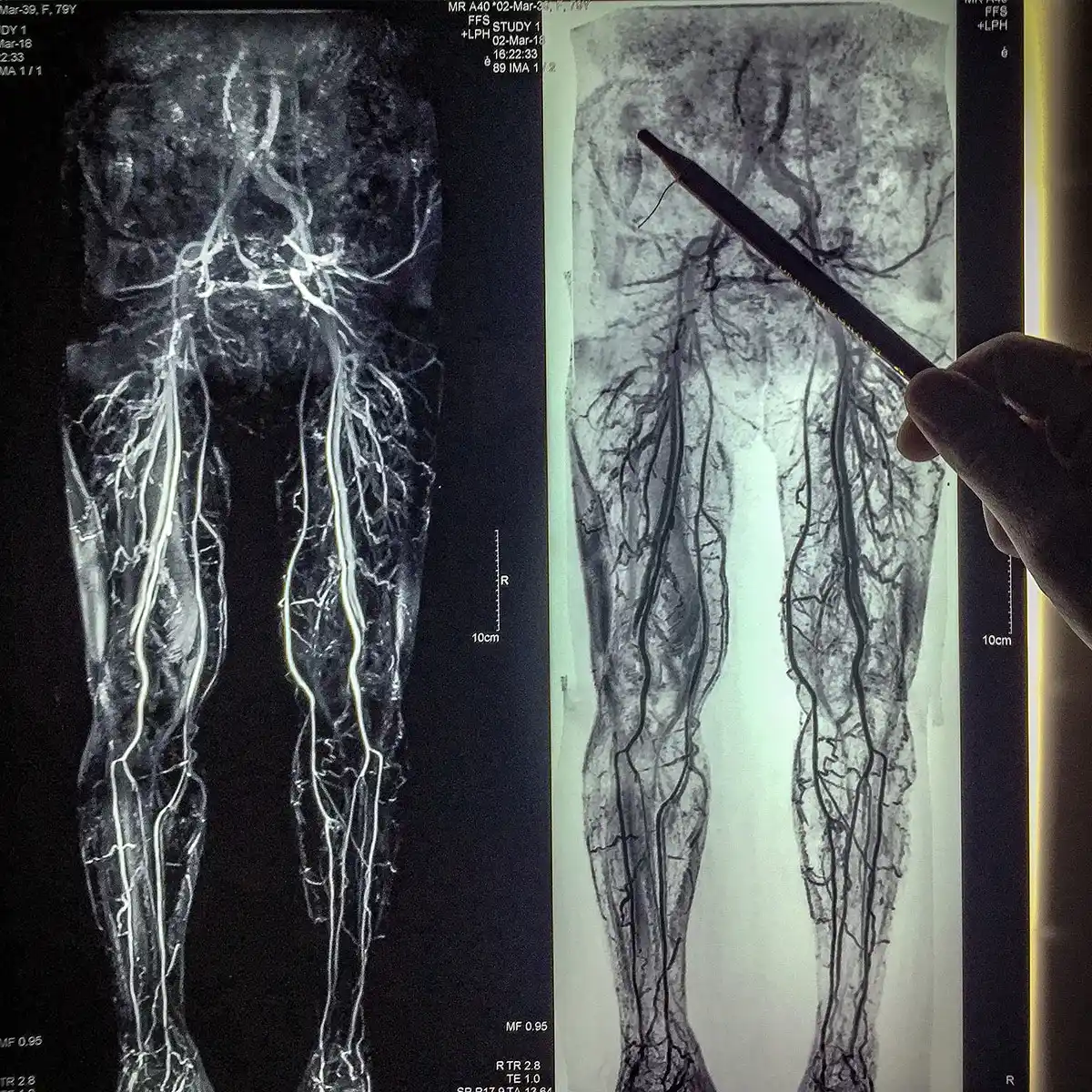 Why Do Varicose Veins Cause Skin Changes?: Center for Varicose Veins: Board  Certified Vascular and Interventional Radiologists