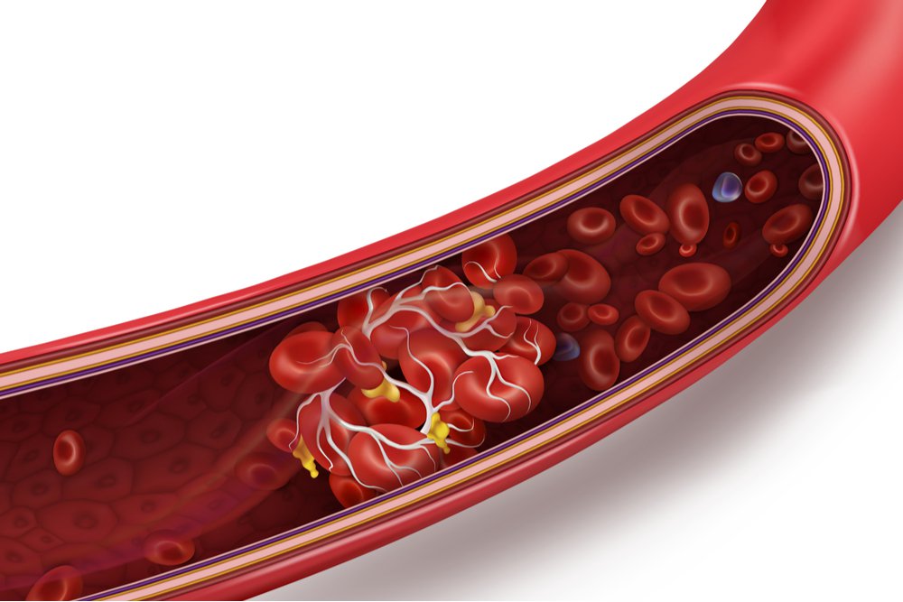 Vascular disease