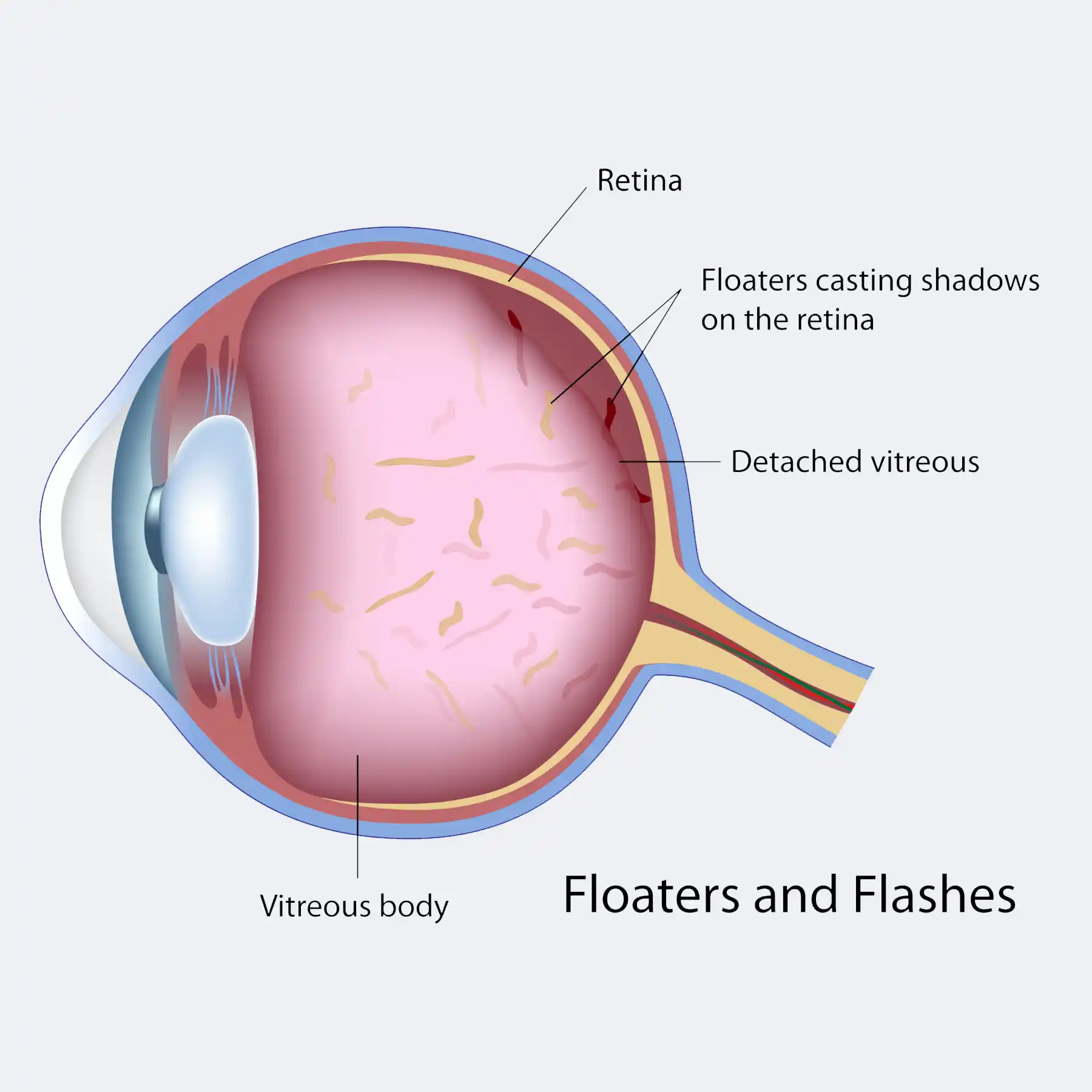 Деструкция стекловидного тела капли. Floaters. Macular disease in the Eye.