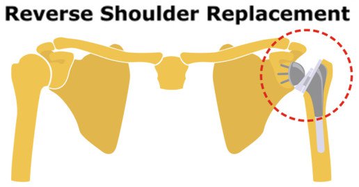 Aribindi-Shoulder-Replacement-uai-516x269_bYlwArC.jpeg (Aribindi-Shoulder-Replacement-uai-516x269.webp)