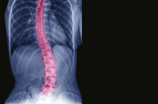 Aribindi-scoliosis-southland-ortho-uai-516x340_pNq4suG.jpeg (Aribindi-scoliosis-southland-ortho-uai-516x340.webp)