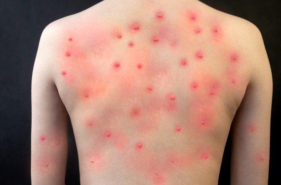 Got rashes? How do you know it's Monkeypox, not something else?