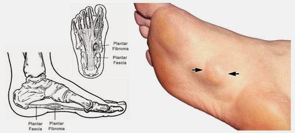 PlantarFibromatosis.jpeg