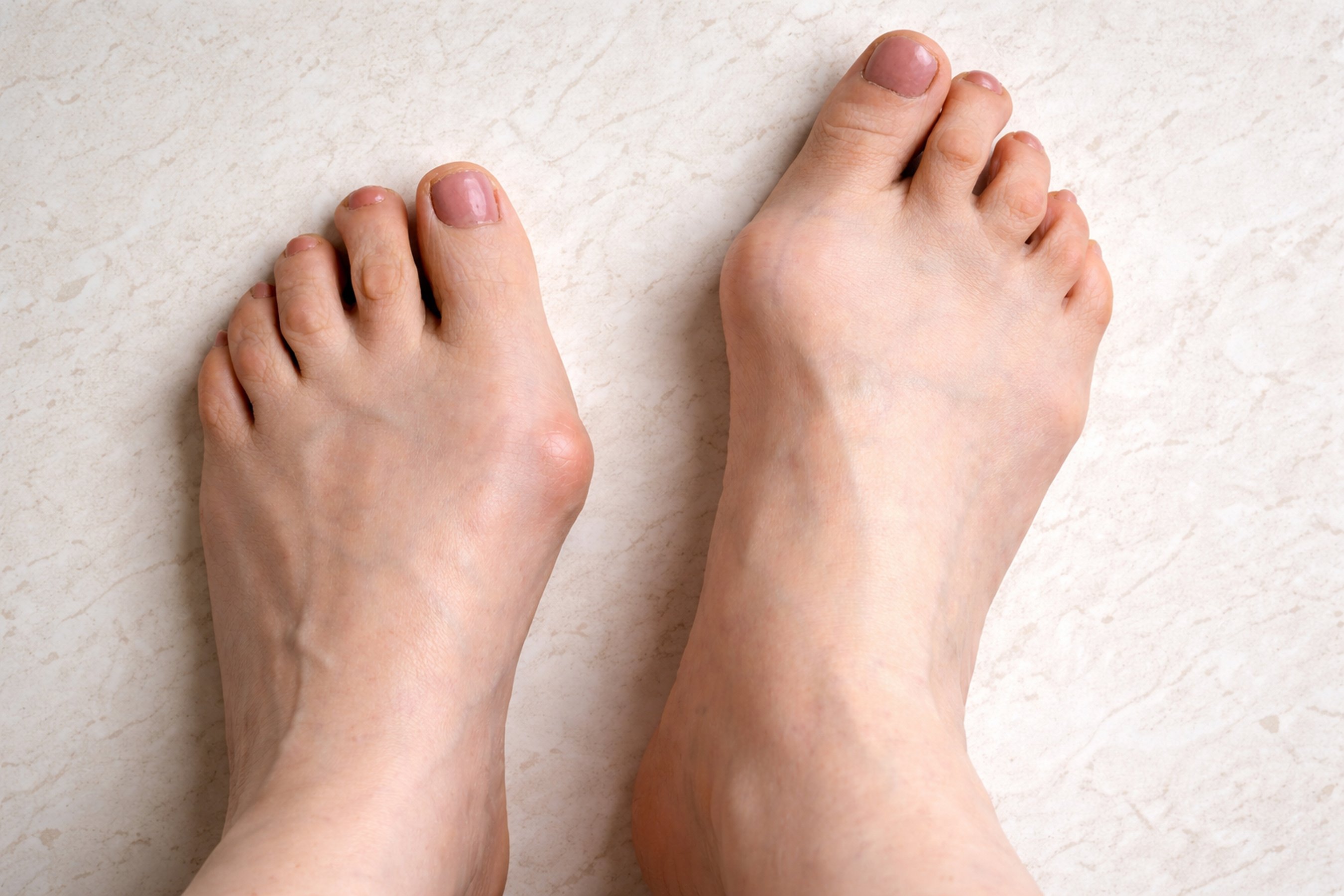 Hallux valgus big abnormal feet bones