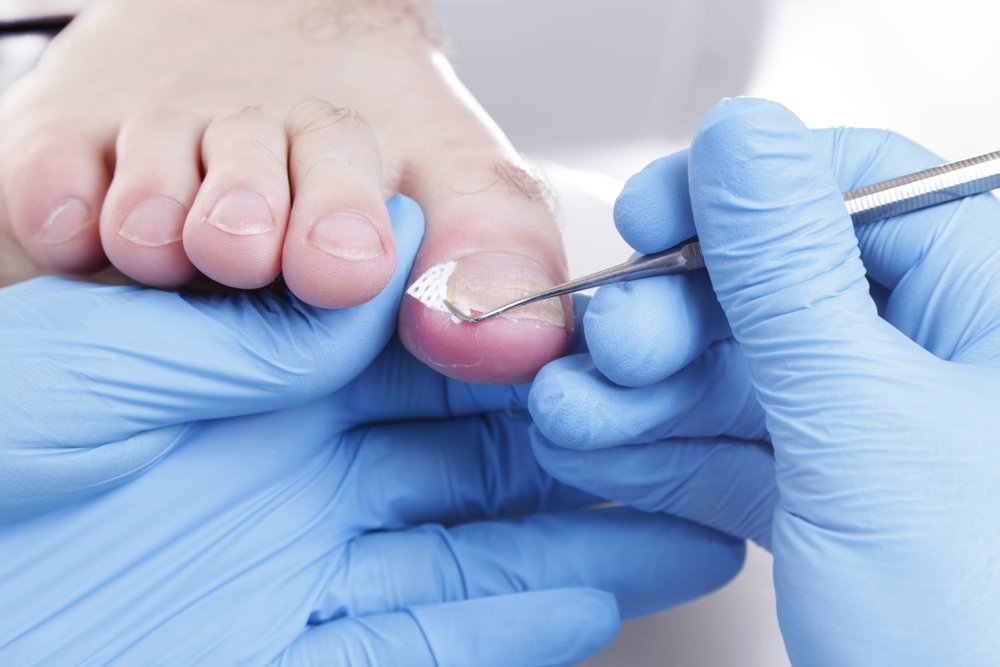 Ingrown Toenails Removal - Footprint