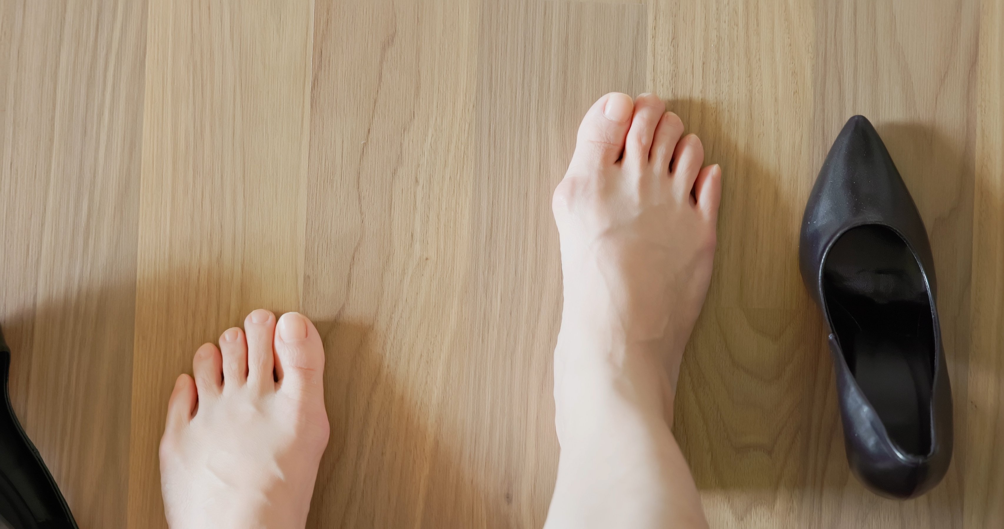 woman with Hallux valgus because she wears stilettos or high heels for long time
