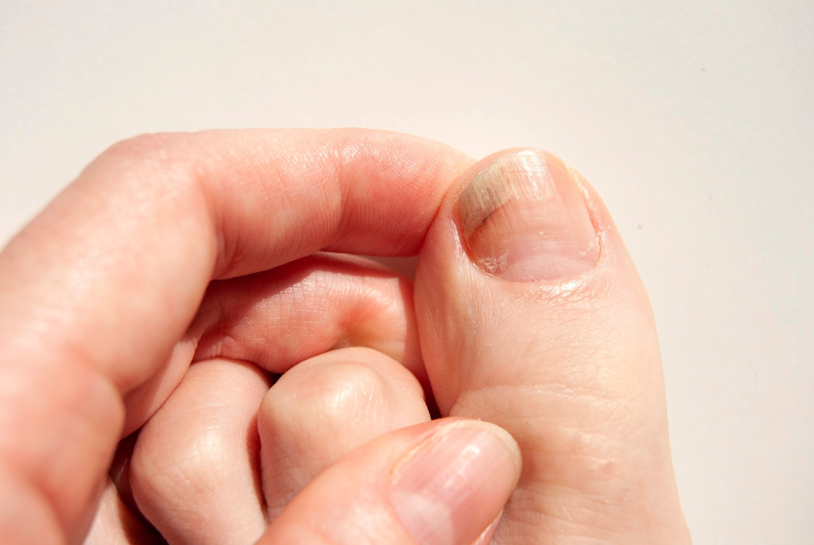 Fungal nails