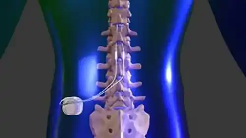 Who Should Consider a Spinal Cord Stimulator?  Pain Management &  Anesthesiology located in Augusta, Austell, Brookhaven, Camp Creek,  Piedmont/Atlanta, Sandy Springs, Canton, Carrollton, Cartersville, Conyers,  Covington, Dallas, Douglasville, Jasper