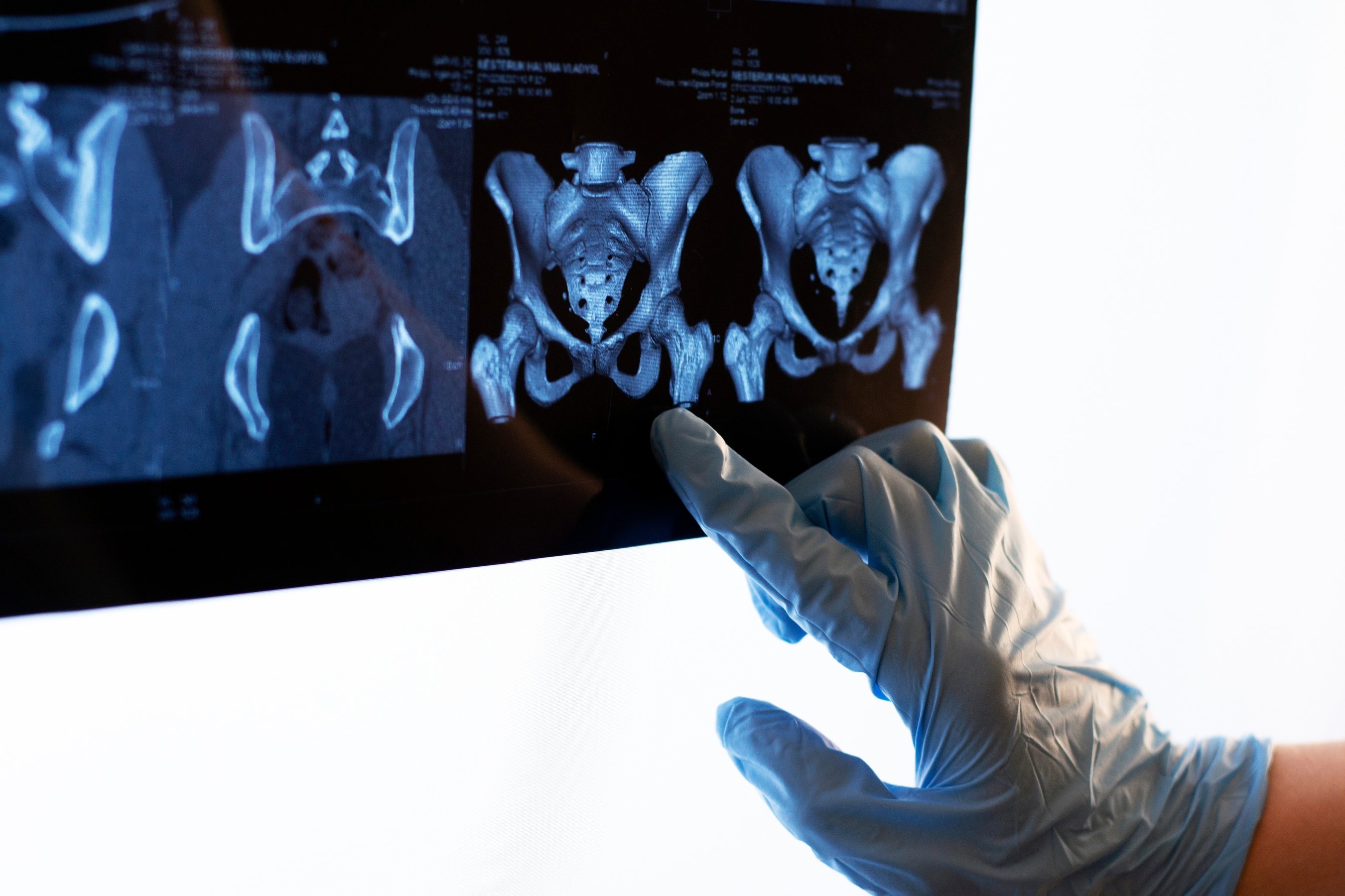 Hand holding Computed tomography image of SI