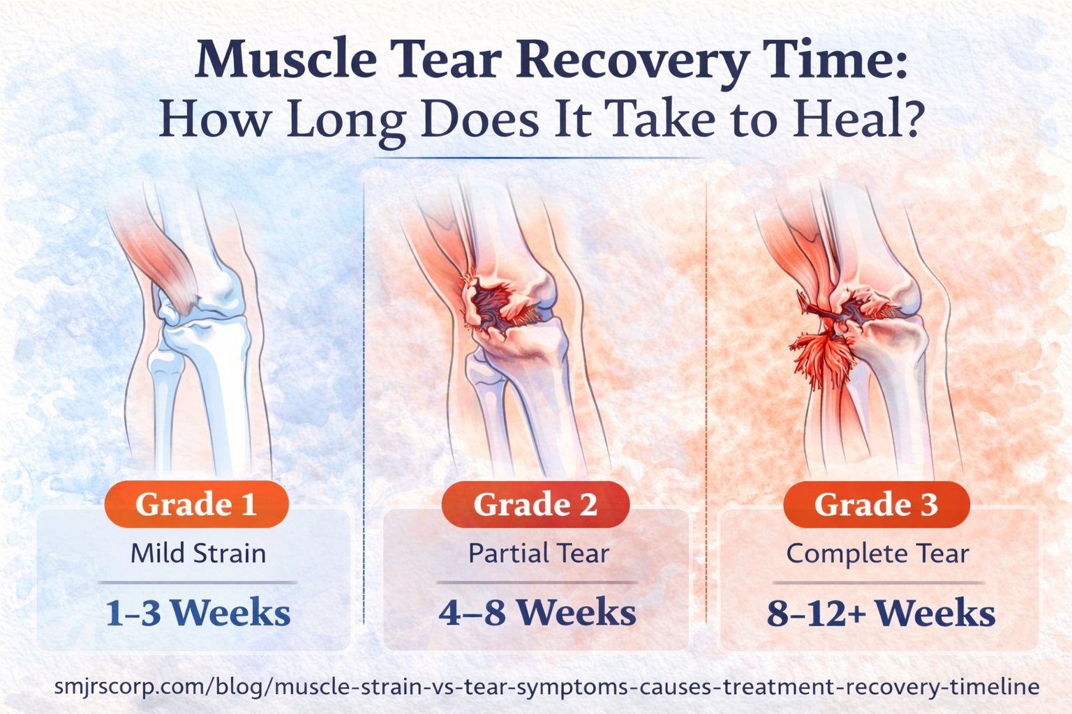 Muscle tear recovery time explained. Learn how long strains and tears take to heal, key symptoms, and when to see a sports medicine doctor.