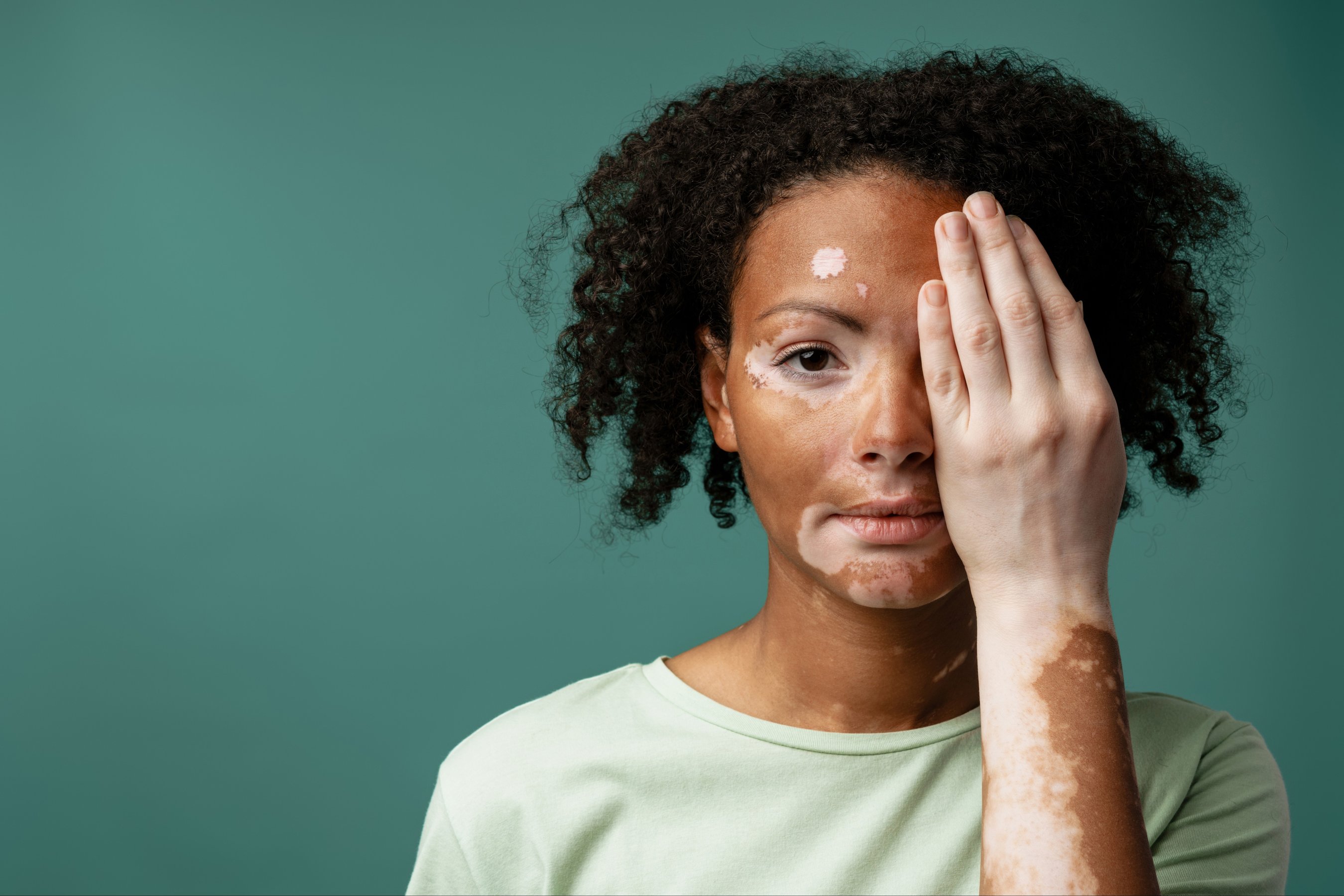 woman with vitiligo condition