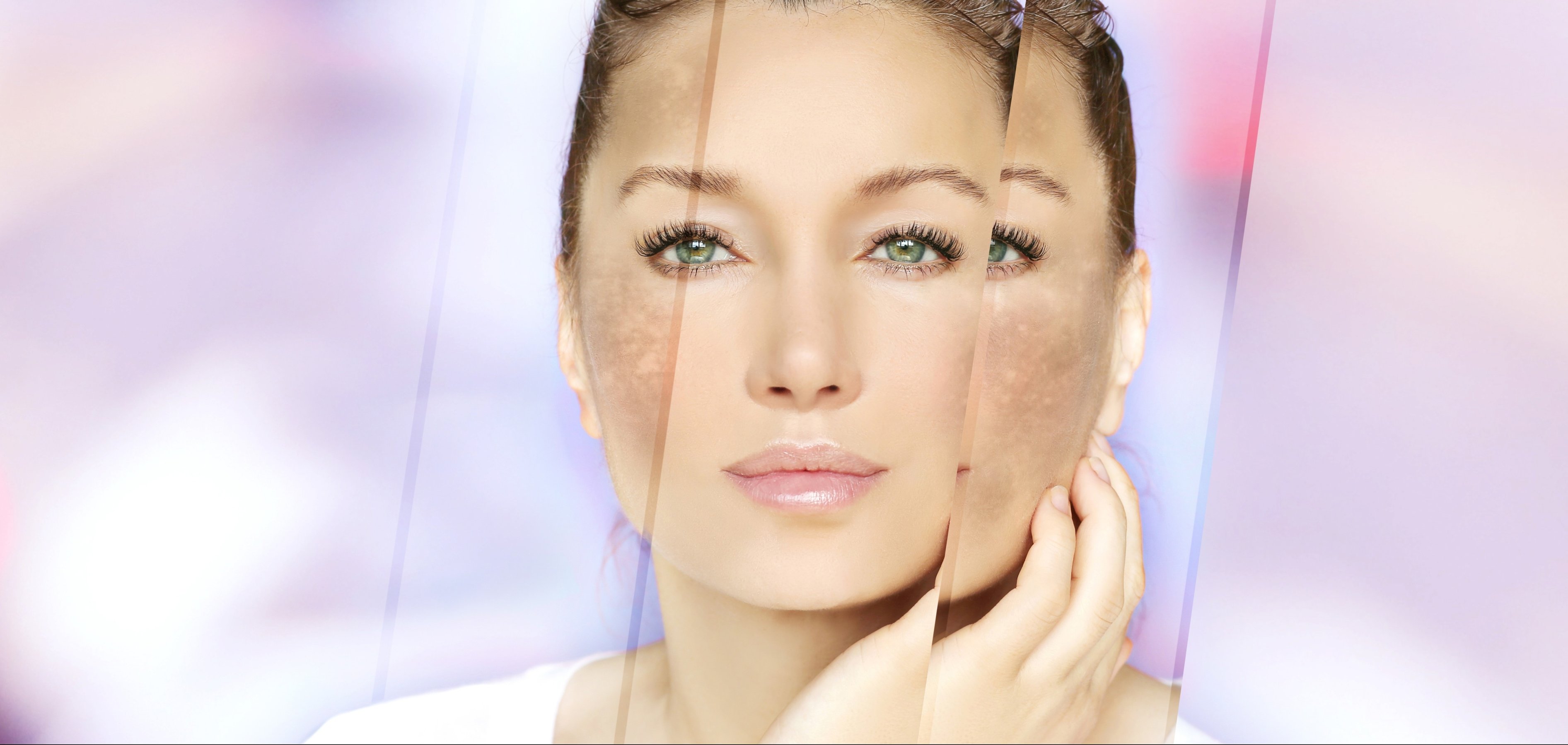 Hyperpigmentation
