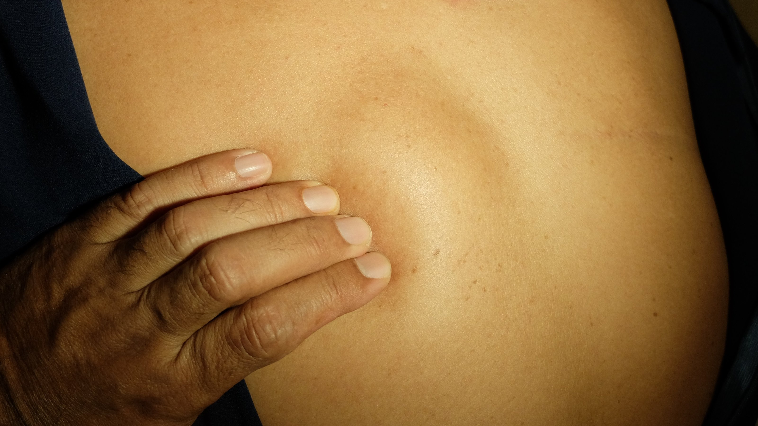 Soft tissue swelling