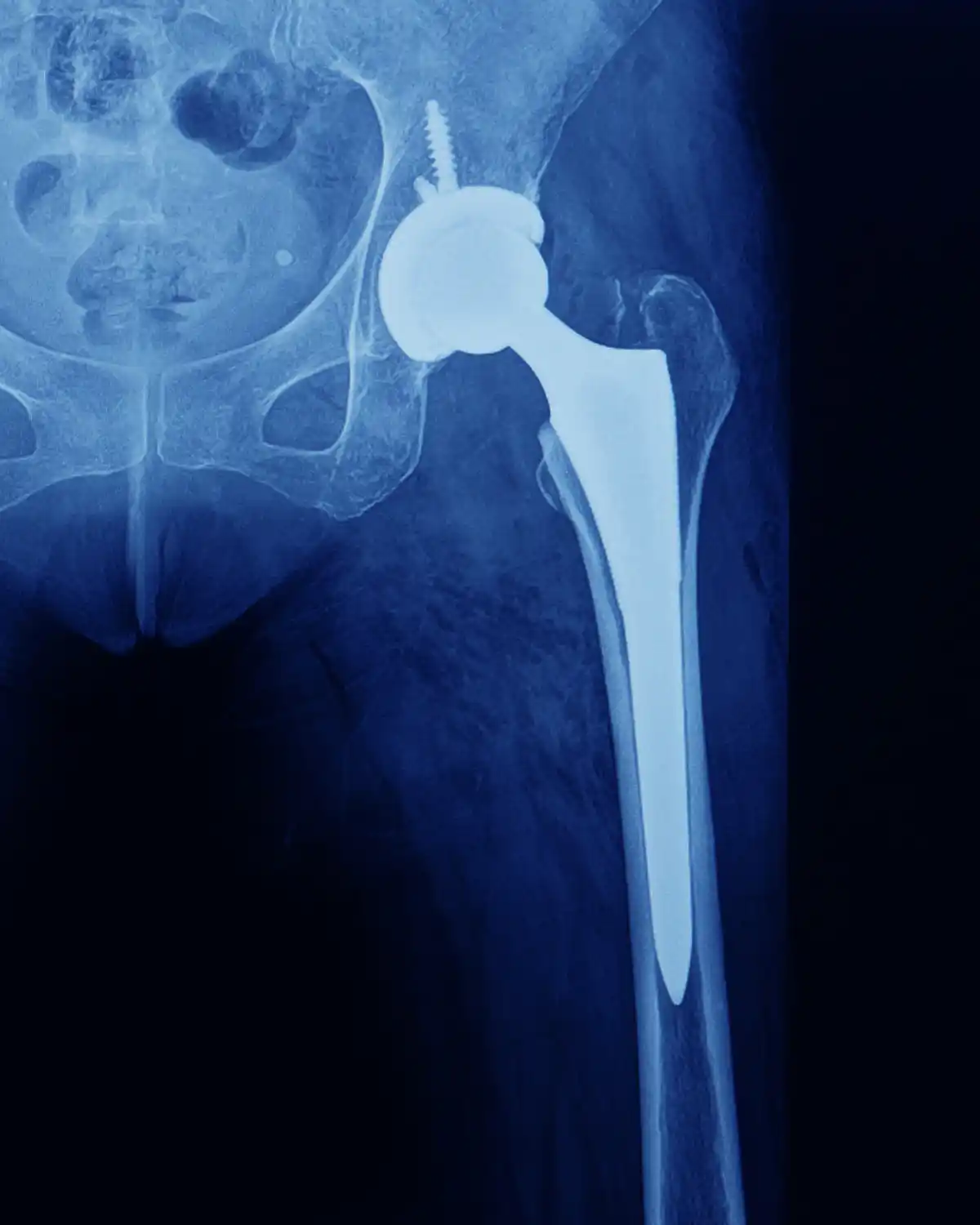 Hip Replacement Surgery  Orthopedic Surgeons Pittsburgh PA