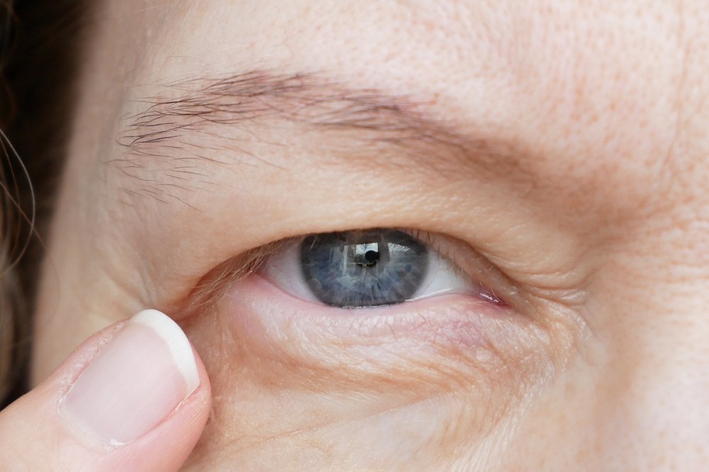 Improve Your Vision with Surgery for Ptosis