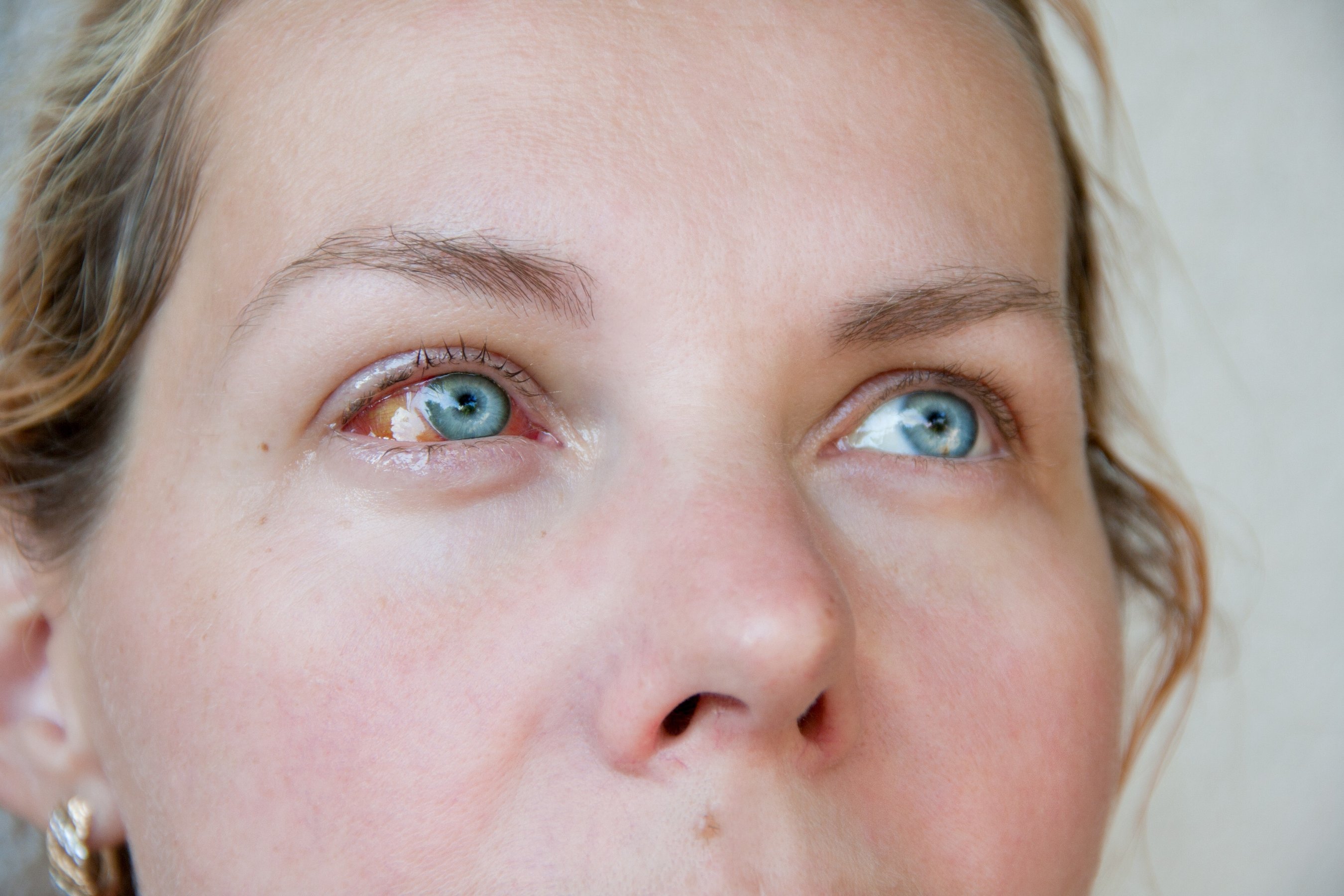 woman right eye is sick with keratitis