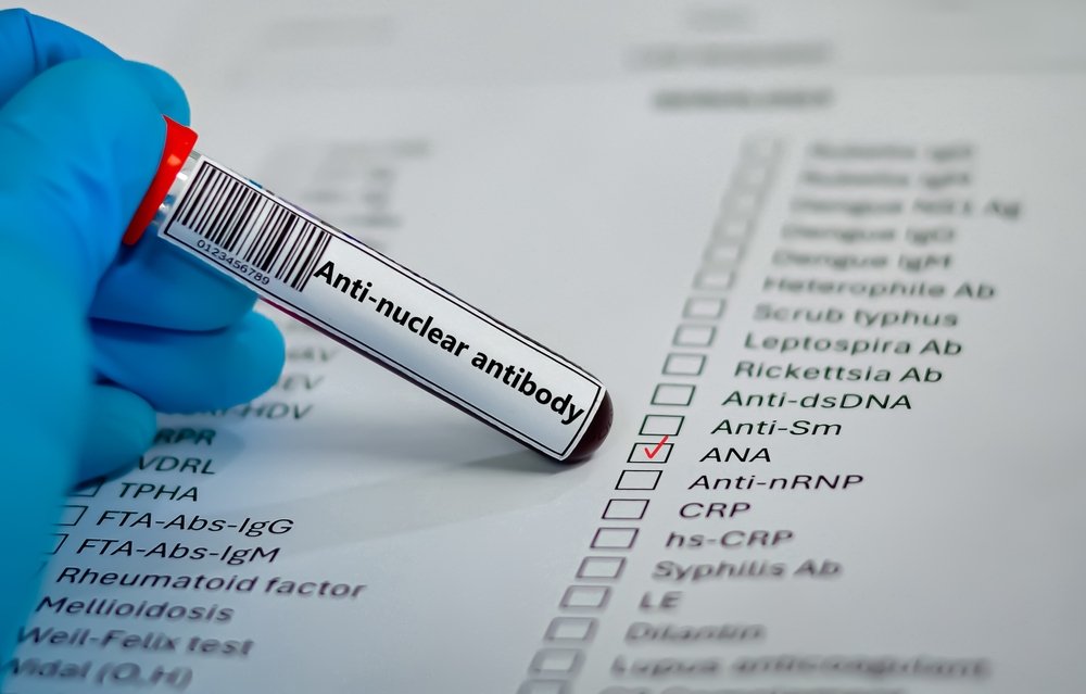 Blood sample tube for anti-nuclear antibody (ANA) test analysis.