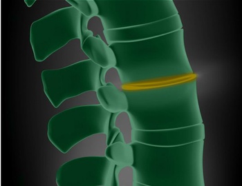 Degenerative Disc Disease Treatment | Spine Doctor Near Me