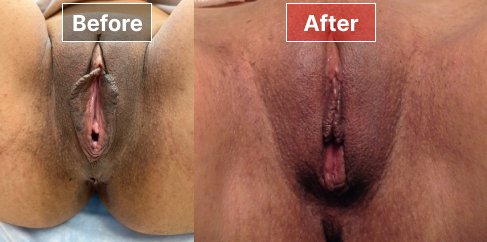 Labiaplasty - before and after - 11