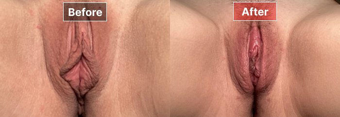 Labiaplasty - before and after - 2