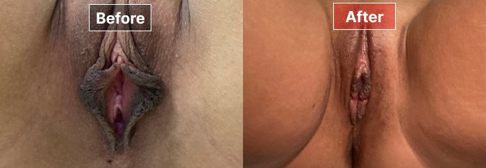 Labiaplasty - before and after - 3