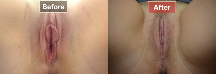 Labiaplasty - before and after - 6