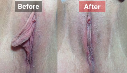 Labiaplasty - before and after - 7