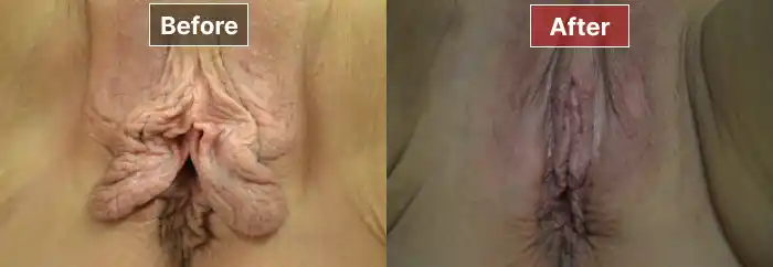 Labiaplasty