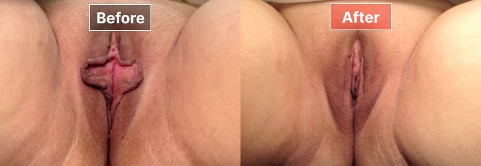 Labiaplasty - before and after - 9