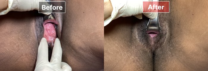 Vaginoplasty