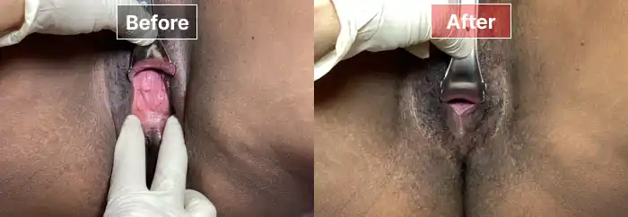 Vaginoplasty 11