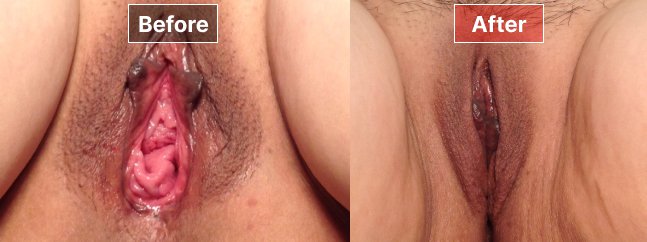 Vaginoplasty- Before and After - 1