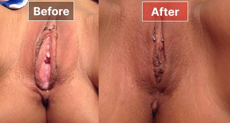 Vaginoplasty- Before and After - 4