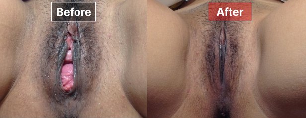 Vaginoplasty- Before and After - 5