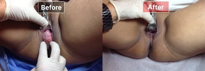 Vaginoplasty- Before and After - 6