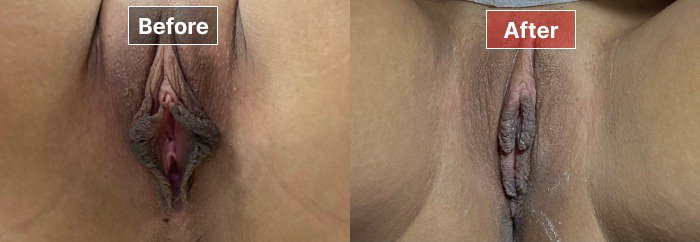 Labiaplasty - before and after - 1