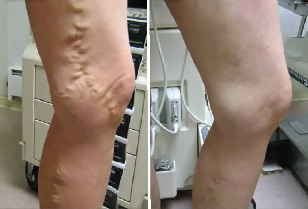 Vein Condition