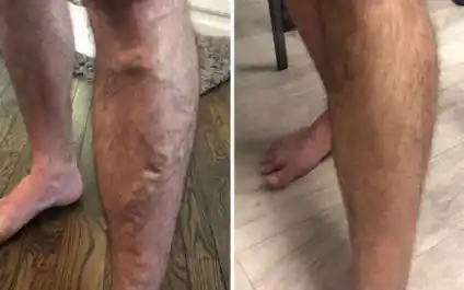 Vein Condition