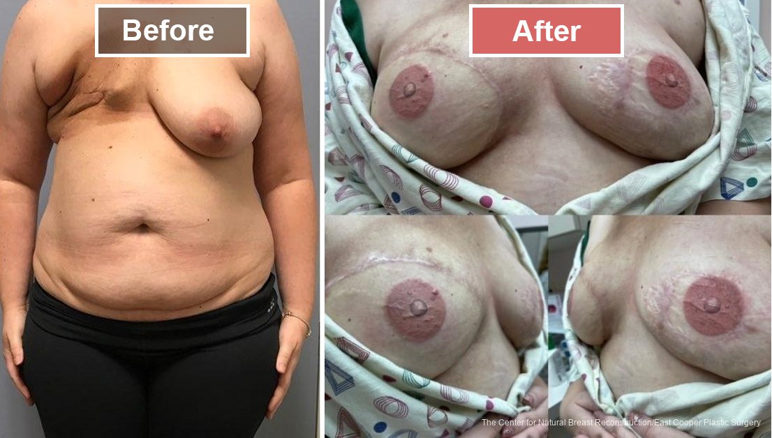 3-D Nipple Tattoos treatment before and after - 5