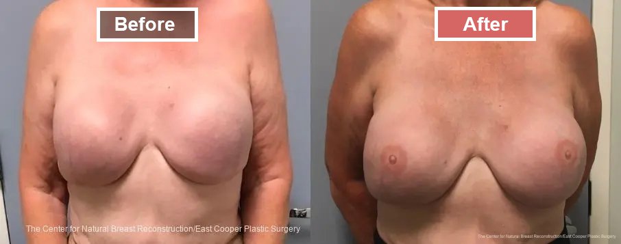 3-D Nipple Tattoos treatment before and after - 8