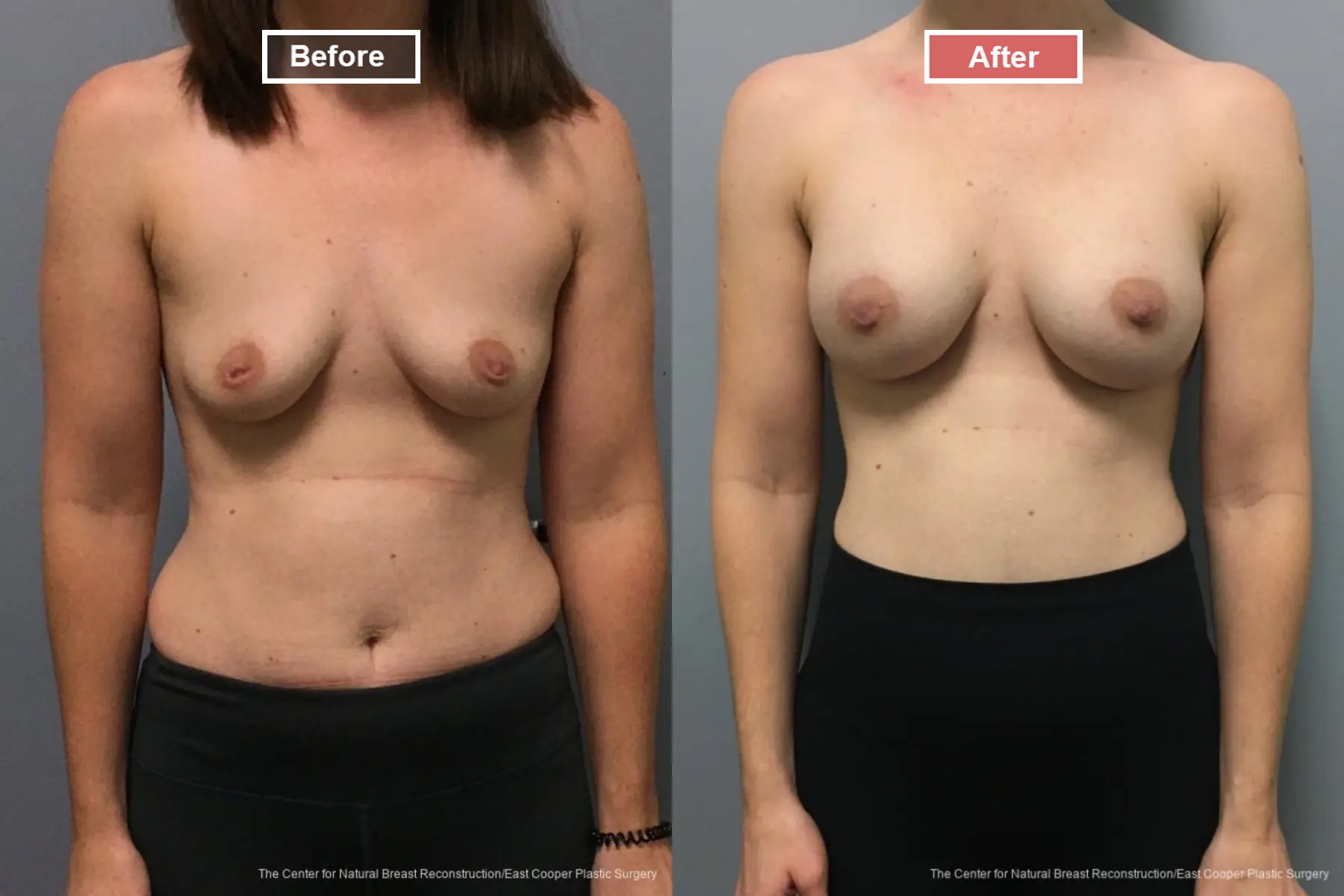 Breast Augmentation treatment before and after