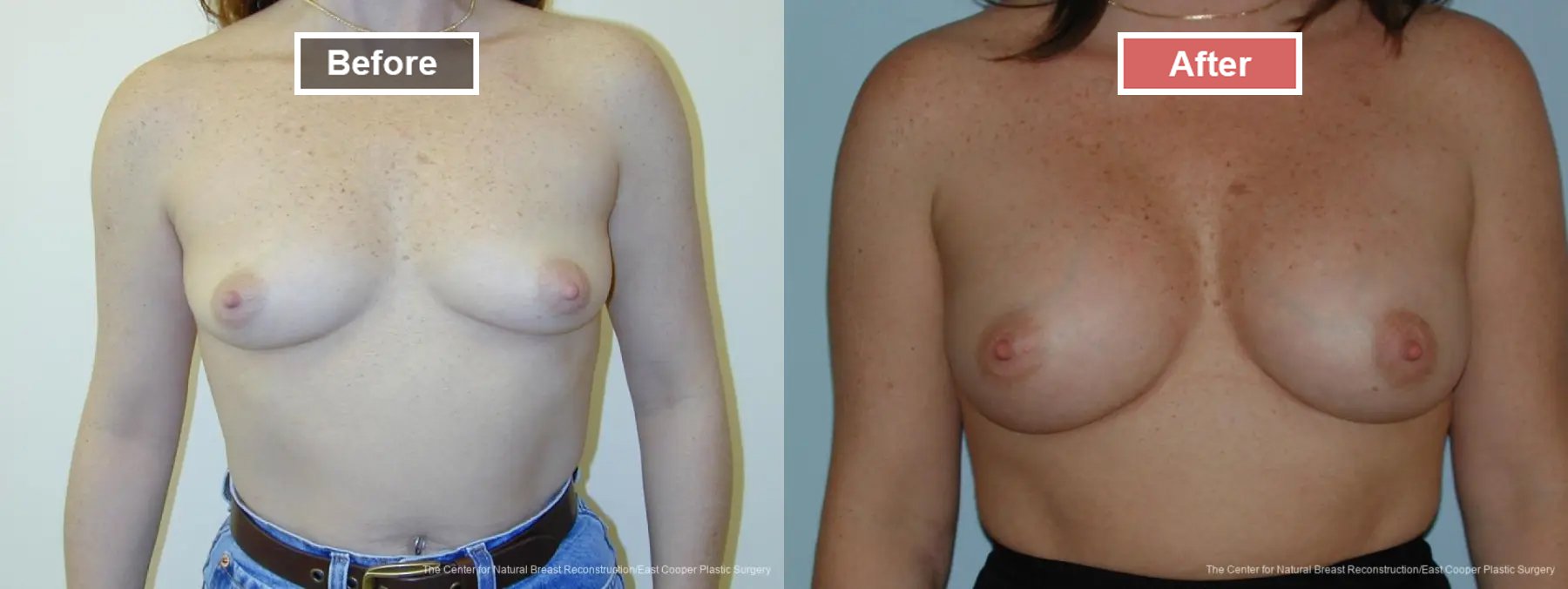 Breast Augmentation before and after