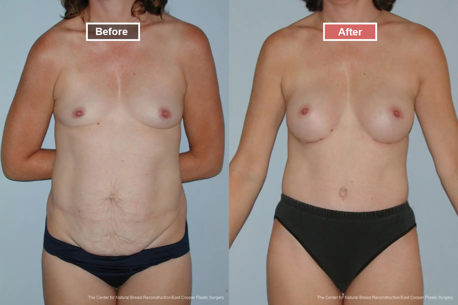 Breast Augmentation treatment before and after - 3