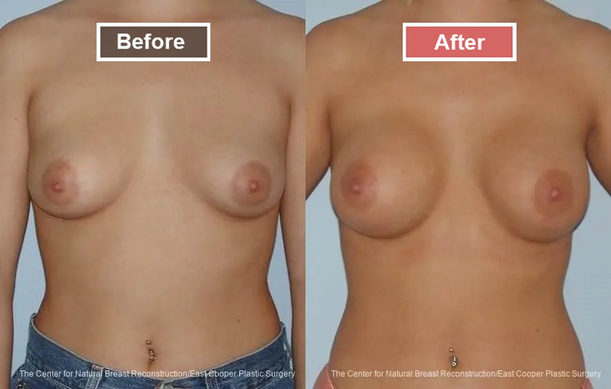 Breast Augmentation treatment before and after - 4