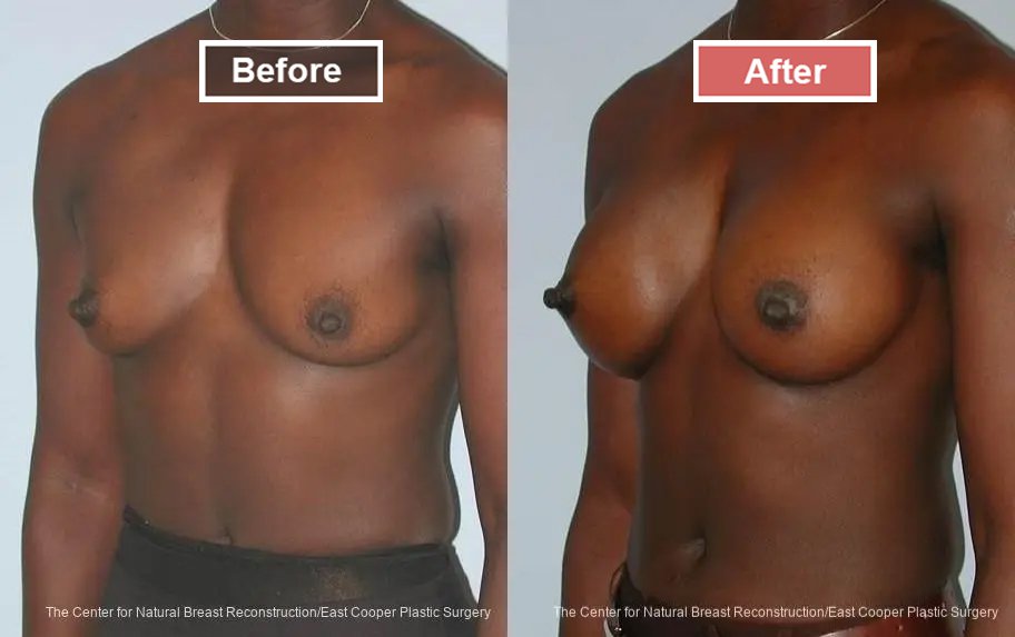 Breast Augmentation treatment before and after - 5