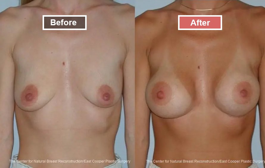 Breast Augmentation treatment before and after - 6