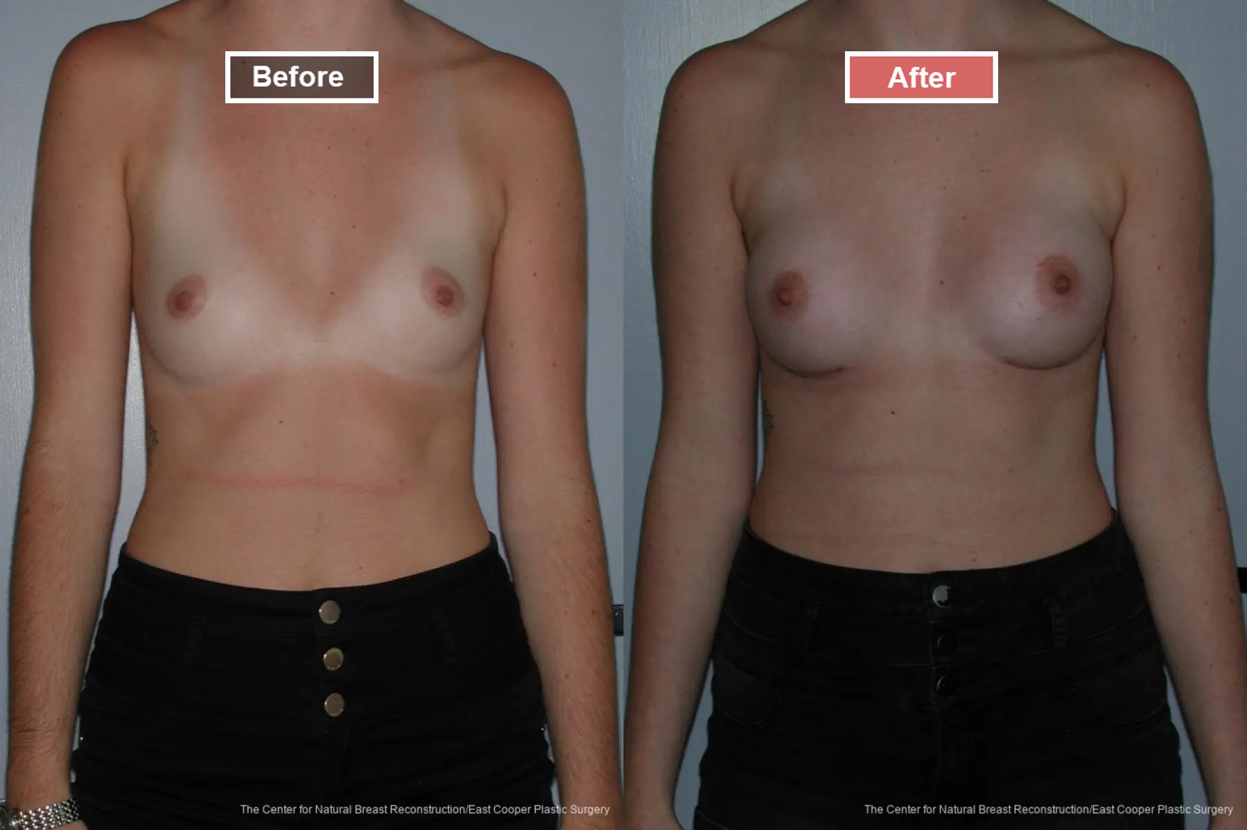 Breast Augmentation treatment before and after - 7