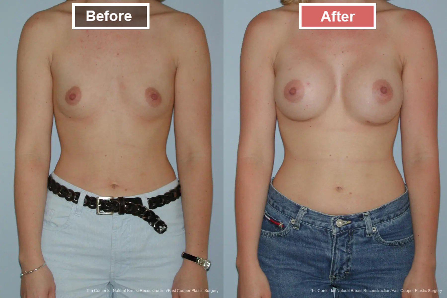 Breast Augmentation treatment before and after - 10